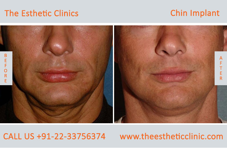 chin Augmentation, chin Implants surgery before after photos in mumbai india (3)